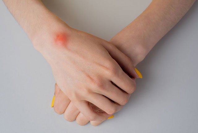 Essential Oils for Ganglion Cysts