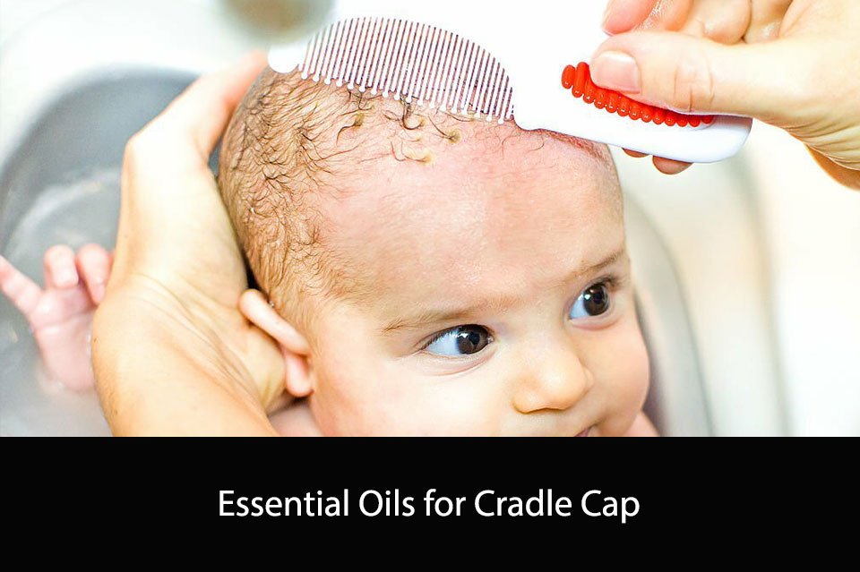 Essential Oils for Cradle Cap
