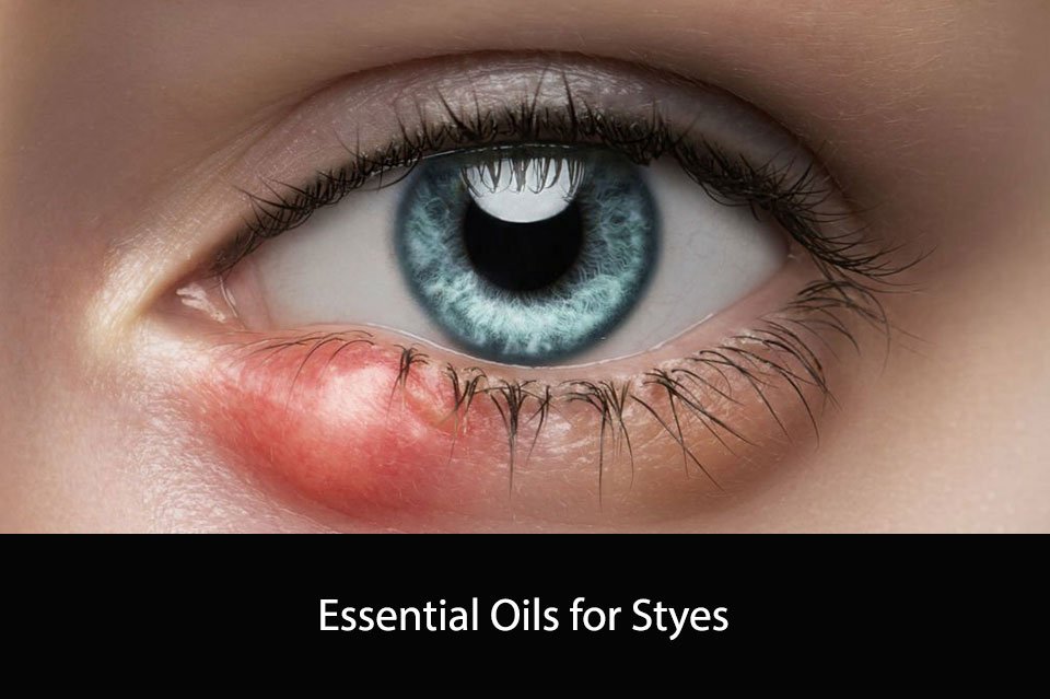 Essential Oils for Styes